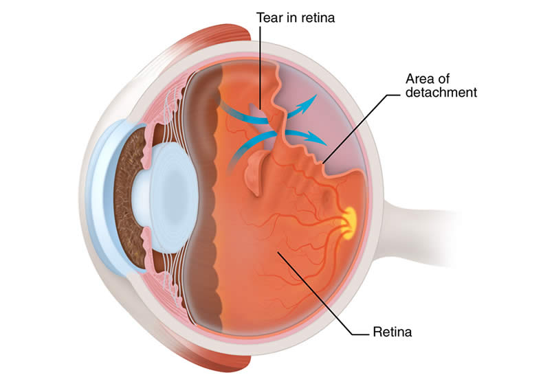 What is Retinal Detachment and How to Treat It