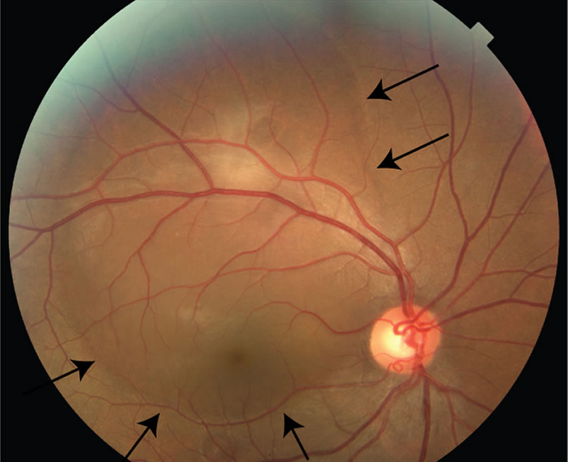 Wavy Lines In Vision Pregnancy Change Comin