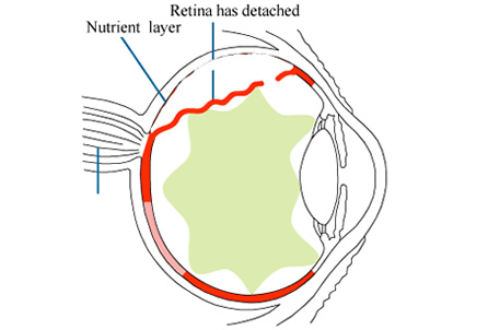 RetinalDetachment1