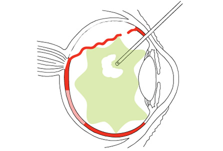 RetinalDetachment2