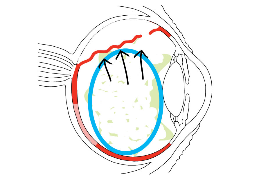 What Is a Detached Retina? - Outlook Eyecare