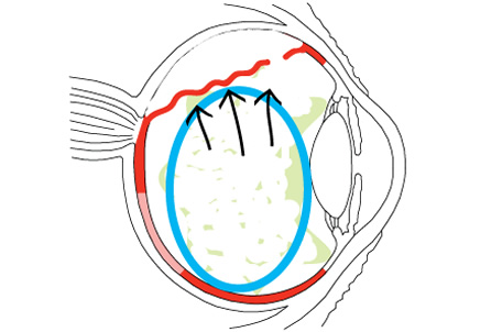 RetinalDetachment3