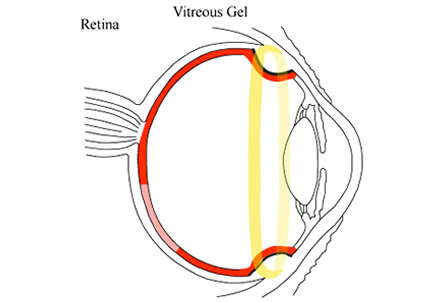 RetinalDetachment4